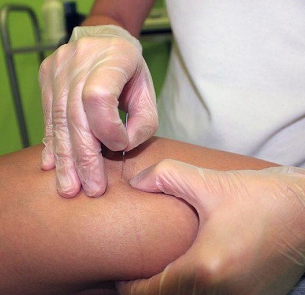 Sesiones de Fisioterapia - Puncion seca en Alcalá de Henares